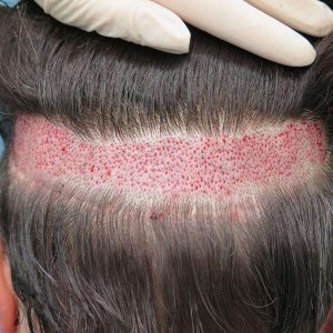 FOLLICULAR UNITEXTRACTION (FUE)